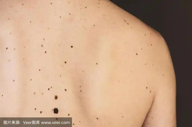 男人背上的痣.