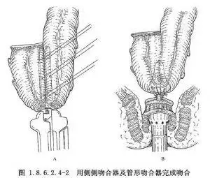 5cm的侧侧吻合器进行,长度为5～10cm,一般认为5cm贮袋效果最好,因为小