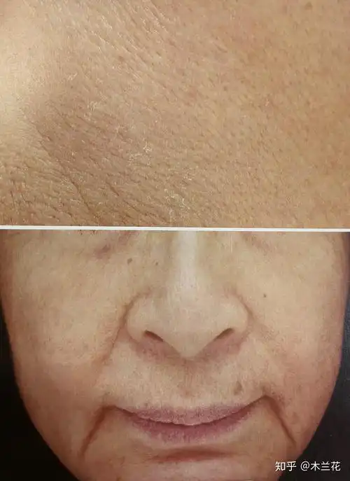 岁月无情,这种皱纹,通常还伴随面部的下垂,内部的皮肤衰老是根本原因.