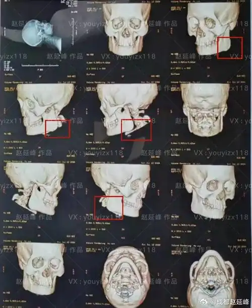 颌面整形赵延峰##下颌骨##面部轮廓##轮廓