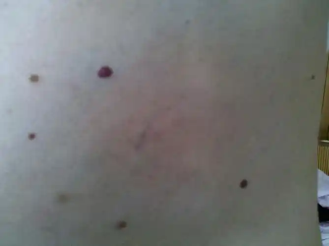 医生您好 我现年50岁 身上胸前及背部有红色痣状物 有些是以前出现的