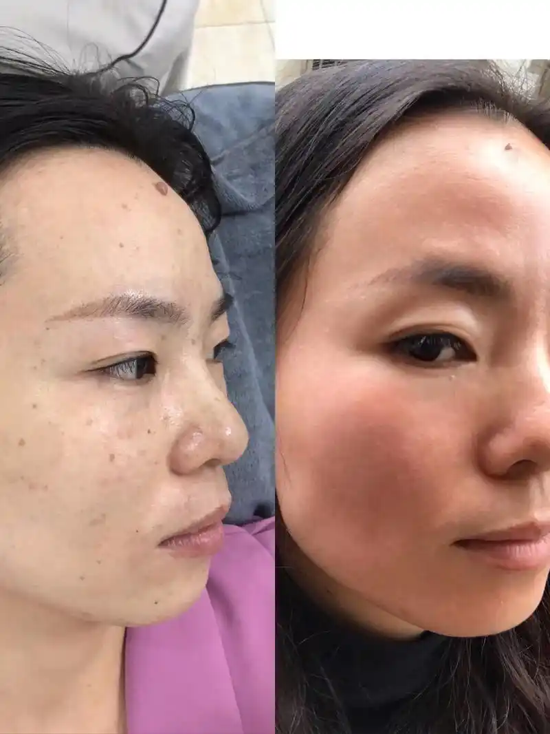 这是本人调肤祛斑前后的一个对比90,好不好让事实说话#祛黄祛 - 抖