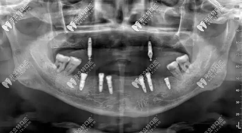 65岁老人全口种了8颗德国camlog种植牙后排骨都敢吃了