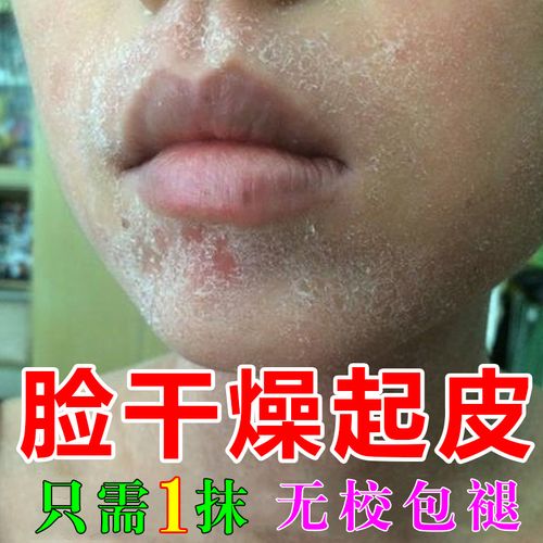 脸干燥起皮爆皮脱皮修复脸起皮男女脸干保湿补水皮肤掉皮护肤油