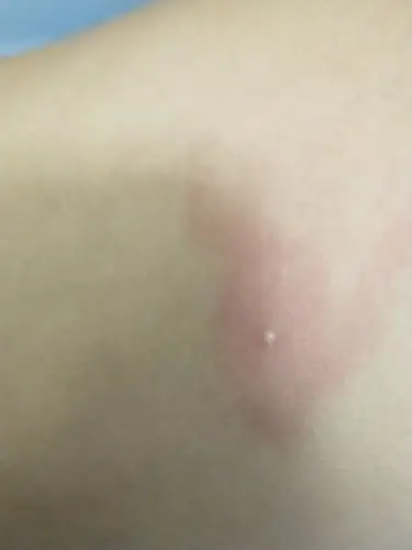 女儿的腋下起了这样的疙瘩