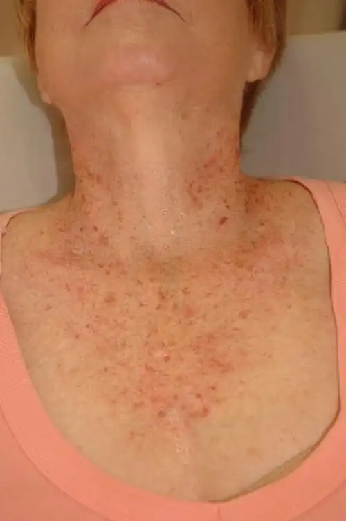 女士脸上长色斑图片_有来医生