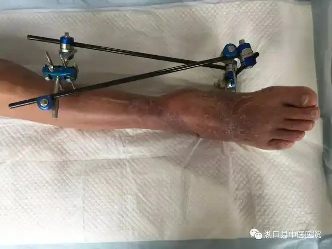 湖口大叔被撞后濒临截肢幸好