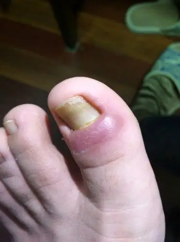 瞬闪极雷| 浏览 40 次  发布于2016-05-01 22:11   最佳答案 甲沟炎!