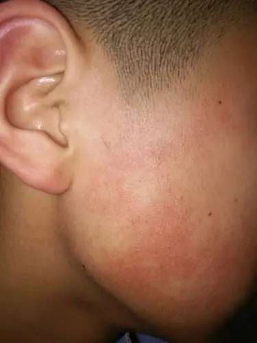 孩子脸上长小疙瘩,皮肤呈红血丝状.偏黑.已有几年了.请问是怎么回事?