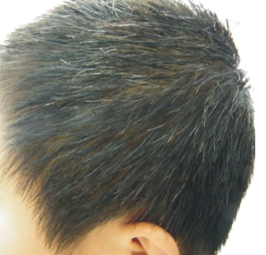 3,少年白是一种儿童及青年时期白发性疾病,少