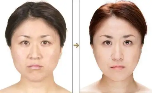 日本整容院惊人对比照 - 美女频道 - 华龙网