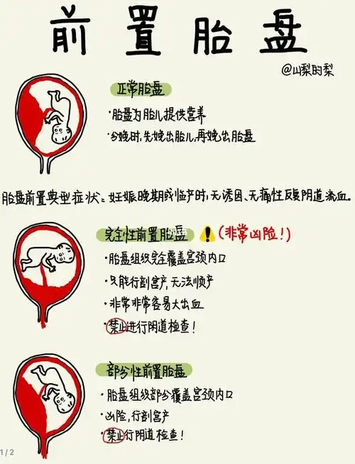医学生笔记|前置胎盘