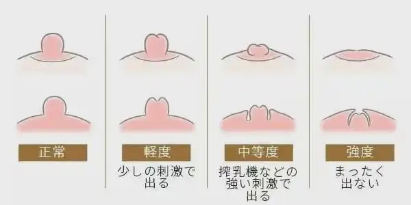 女性的乳头凹陷是怎么回事每个女孩子的咪咪都不一样吗