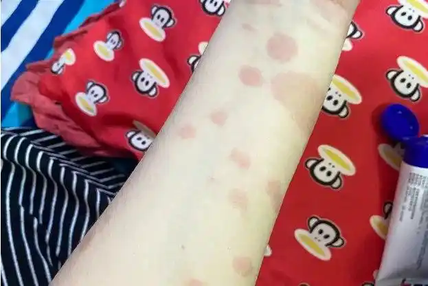 轻度的红斑狼疮症状不明显,活动期可出现发热,乏力,体重减轻,出现皮疹