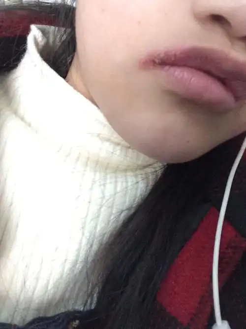 嘴角溃烂,不知道自己吃了什么东西长的.要用什么方法治疗?