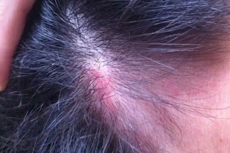 头皮脂溢性皮炎红斑