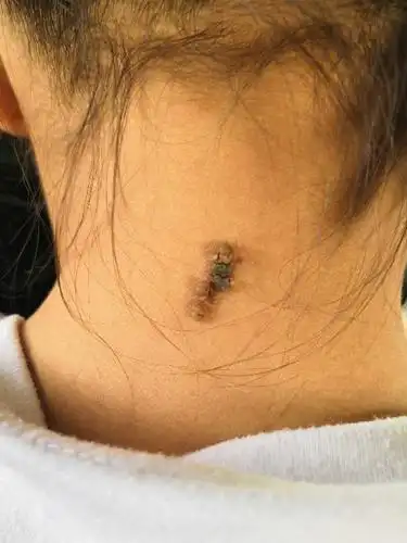 孩子脖子有瘊子,请问怎么治疗