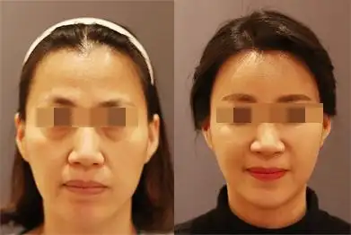 面部填充前后效果对比