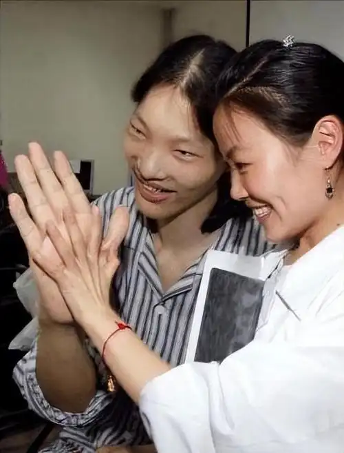 世界最高女人姚德芬:身高2.36米的坎坷人生