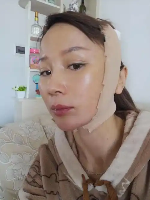 今天是做小切口拉皮的第4天,脸还有点肿,不过不算特_圈子-新氧美容