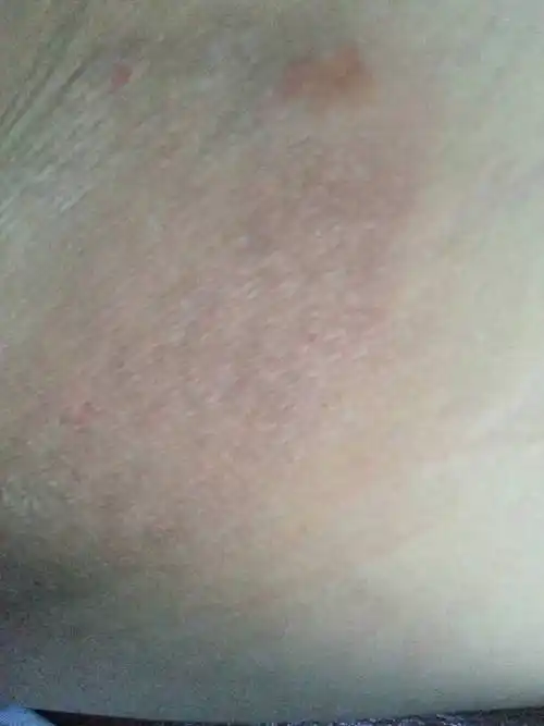 在大腿根部两侧长了两块较大类似皮癣的红斑(似乎有种老化的现象,有是