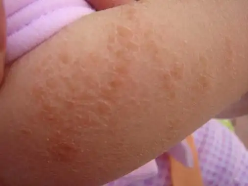 宝宝身上长癣图片 (11)