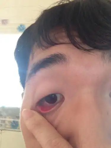 到了昨晚开始只要眨眼睛就会疼,而且下眼皮开始肿里面还长了个包.