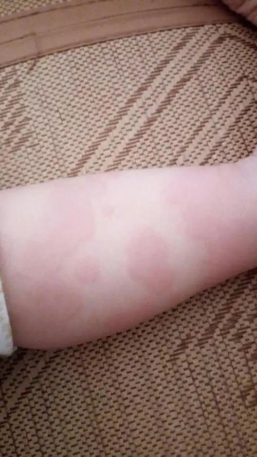 宝宝过敏性皮炎种类,是一个月女宝从昨天开始到现在身上过敏逐渐变成