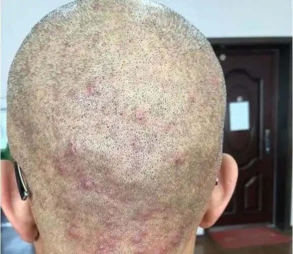 为什么头皮上总长红疙瘩和脓包头皮上总冒出红疙瘩或脓包是怎么回事