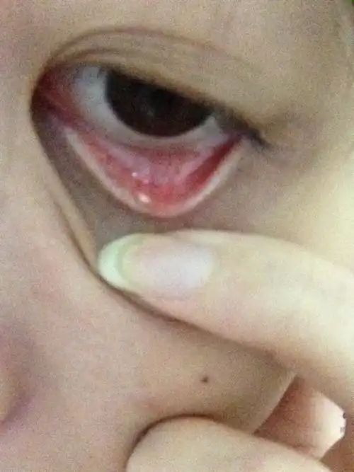 眼科求助,下眼皮里长了一个小白点,有图