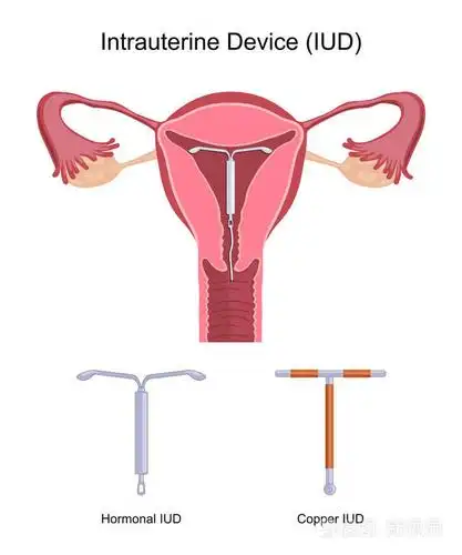 宫内节育器宫内节育器