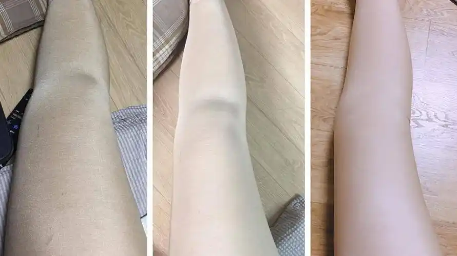 还在担心吸脂之后的皮肤松弛吗?