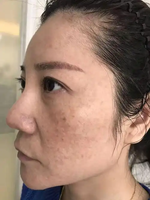 在综合修复皮肤的基础上,屏障健康了,黄褐斑也