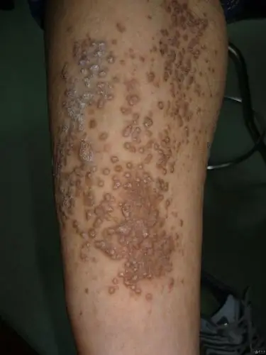 典型病例——苔藓样淀粉样变 - 皮肤及性传播疾病讨论版 - 爱爱医医学