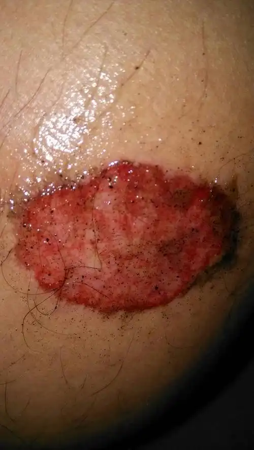 小腿被摩车烫伤 ,起了水泡,不小心弄破了,2天了伤口变红,好像有点化脓