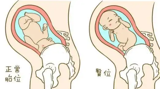 胎位roa是什么意思孕妈定期检查胎位很重要