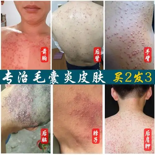 治疗毛囊炎药膏前胸后背部毛囊炎神器去头皮痤疮脓包疙瘩皮肤止痒