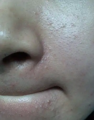 毛孔堵塞才是皮肤痘痘的原因