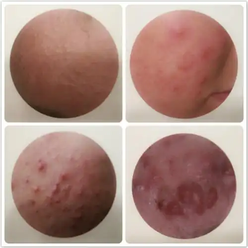 面部痤疮红疹斑块国医大师熊继柏有高招