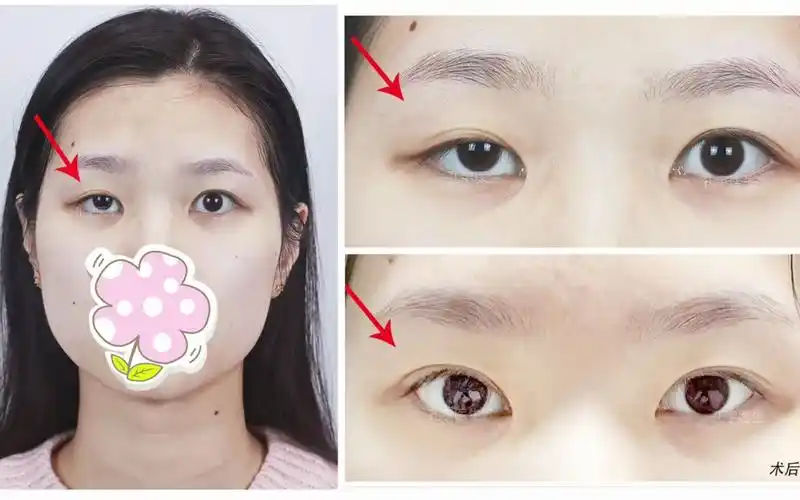 安徽姑娘,右眼先天性上睑下垂,1月前做的矫正 发来反馈照片