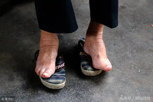 湖北孝感:"三寸金莲"小脚伴随百岁老人 如今走路稳当身体尚好_网易