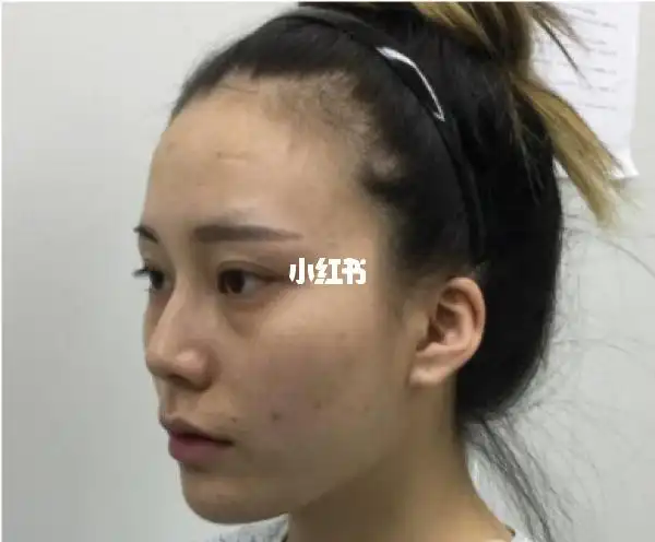 刚做完脂肪填充真的好丑哦还好恢复的比较