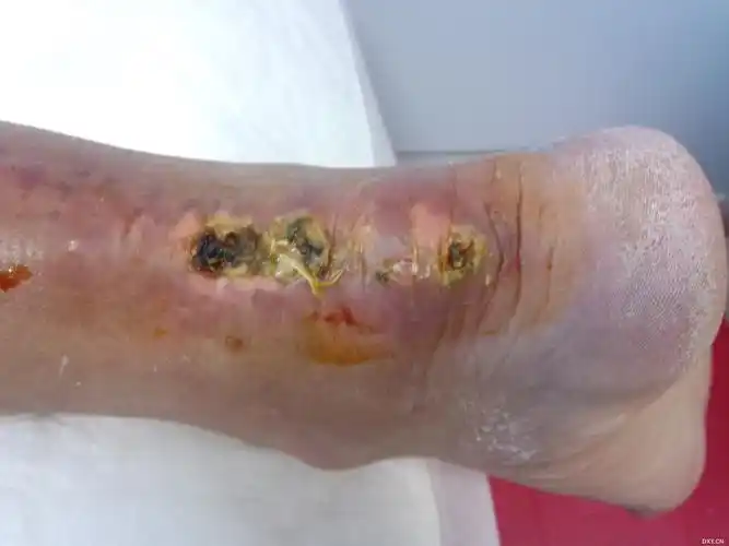 在其他医院因跟腱急性断裂做修补术后,伤口皮肤坏死导致感染