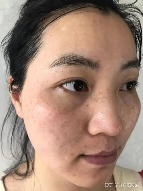 脸上长斑怎么去除?