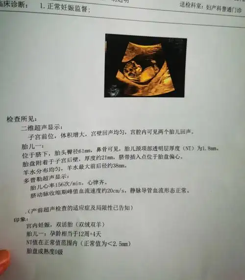 双胎宝宝nt秒过