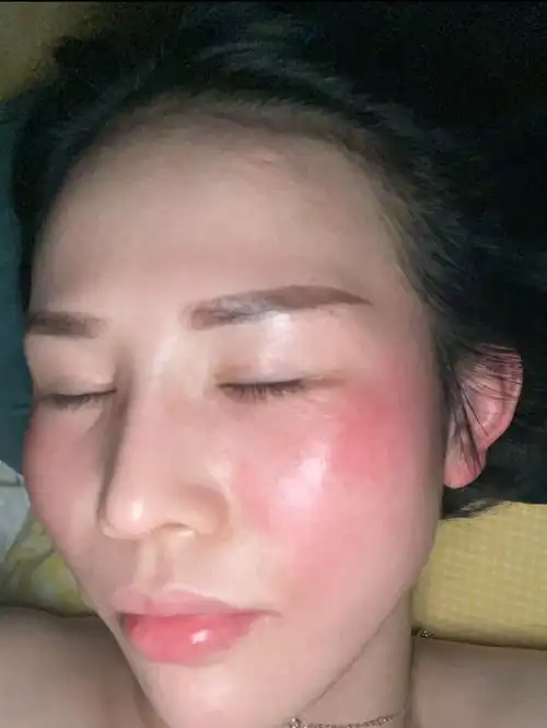 图敏感肌皮肤红的图片脸上过敏发红发痒怎么快速消除抓红了敏感肌真实