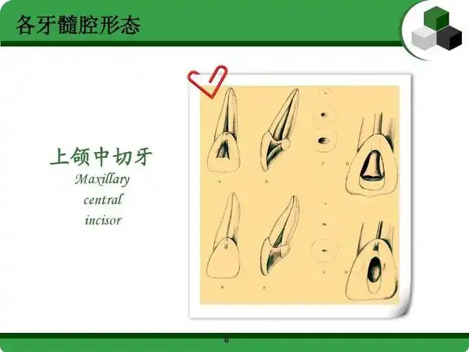 各牙髓腔形态 上颌中切牙 maxillary central incisor
