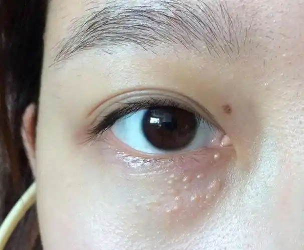 眼部有脂肪粒,5分钟即可轻松去除