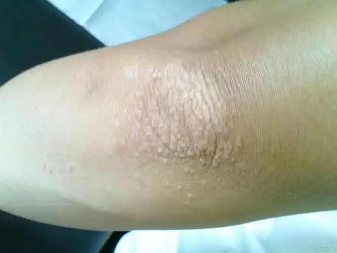 双手肘关节出现丘疹瘙痒一周 - 皮肤及性传播疾病讨