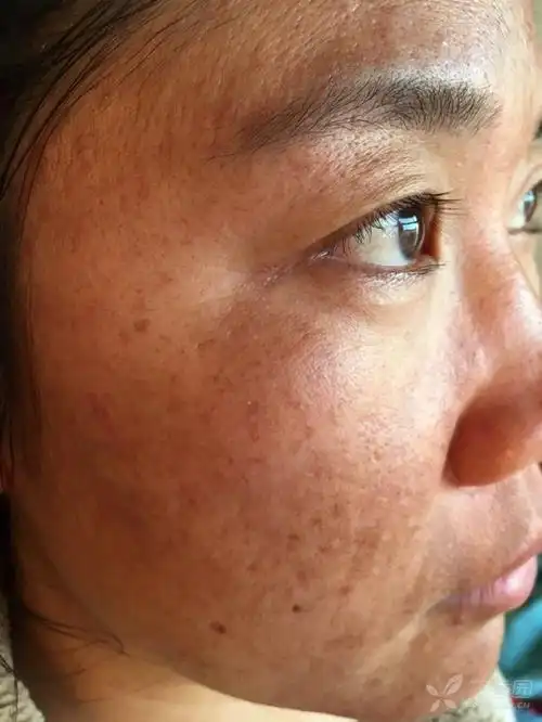 各位同仁,黄褐斑如何正规治疗,方法求教 - 皮肤与性传播疾病讨论版 -